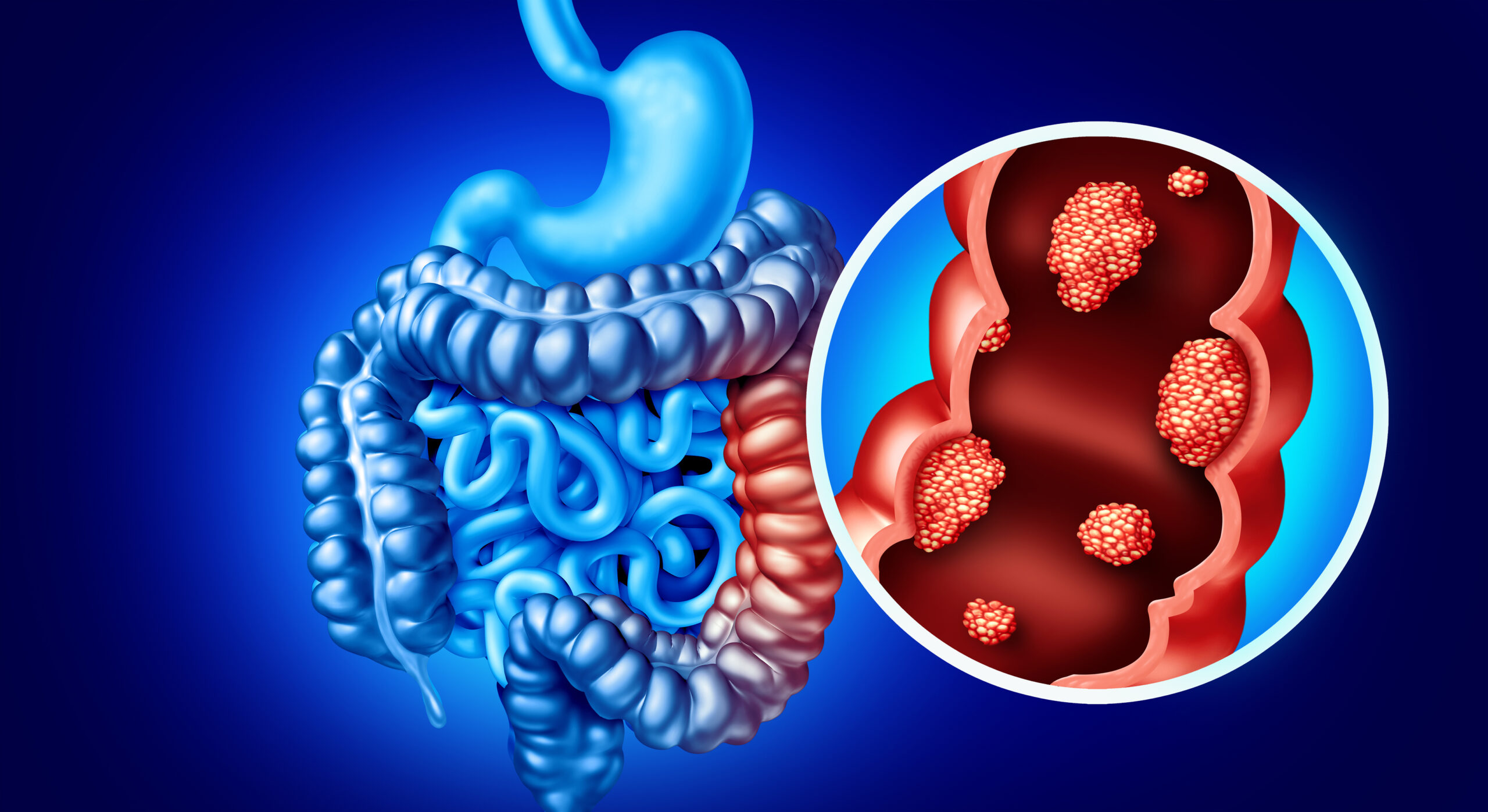 Intelligenza Artificiale in medicina rivoluziona la prevenzione del Cancro al Colon-Retto nella Colite Ulcerosa